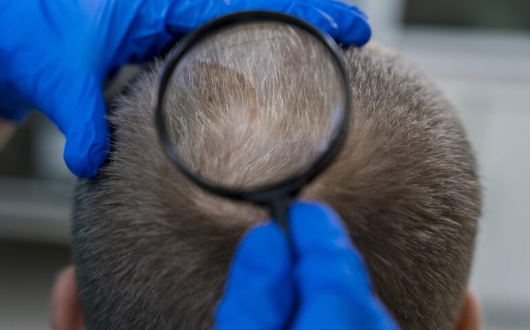 adult-male-having-balding-problems
