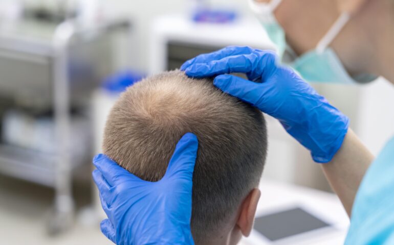 mature-man-having-balding-problems